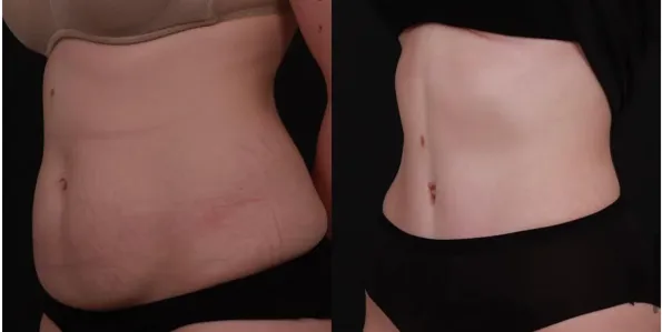 Mommy Makeover voor- en naresultaten in Turkije – casus 193