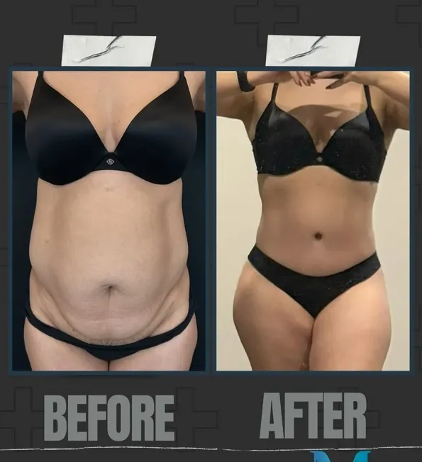 Mommy Makeover voor- en naresultaten in Turkije – casus 206