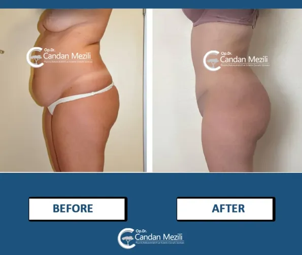 Mommy Makeover voor- en naresultaten in Turkije – casus 594