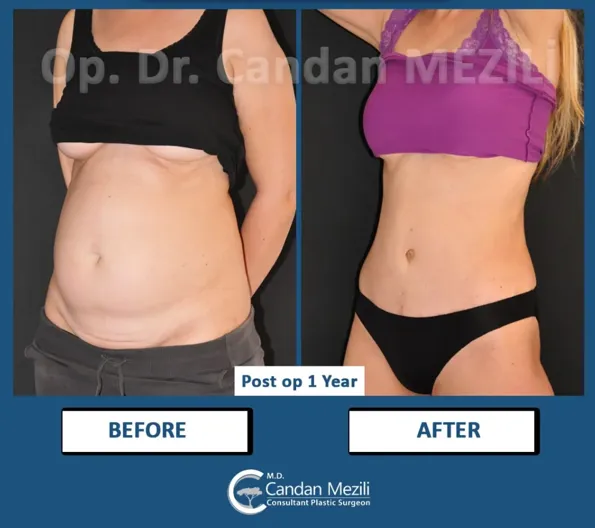 Mommy Makeover voor- en naresultaten in Turkije – casus 595