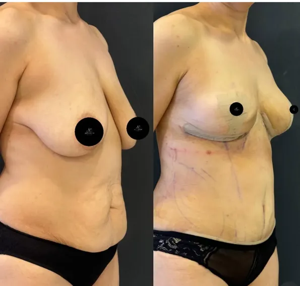 Mommy Makeover voor- en naresultaten in Turkije – casus 70