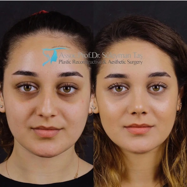 Suleyman  Tas Neuscorrectie (Neusoperatie) results in Turkey – case 280