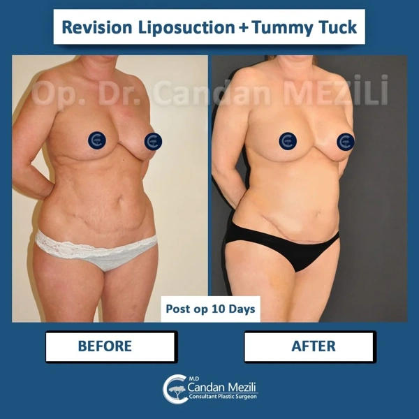 Candan Mezili Abdominoplastie results in Turkey – case 456