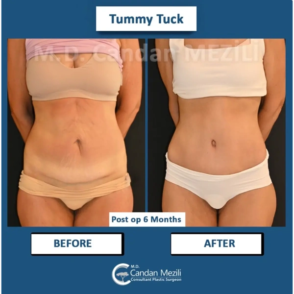 Candan Mezili Abdominoplastie results in Turkey – case 598