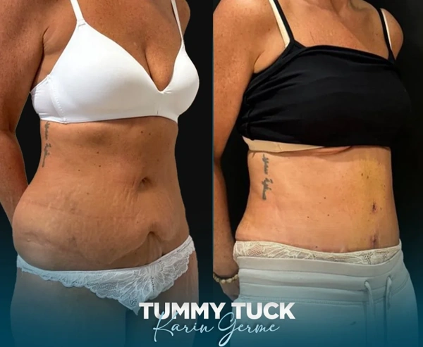 Kamil Manav Abdominoplastie results in Turkey – case 659
