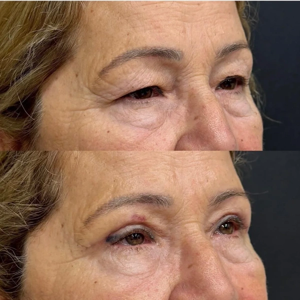 Cem Berkay  Sinaci Blefaroplastie (Operație la pleoape) results in Turkey – case 323