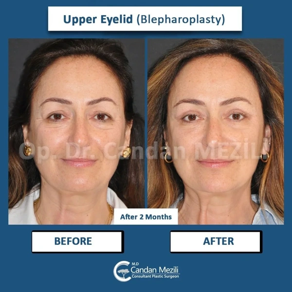 Candan Mezili Blefaroplastie (Operație la pleoape) results in Turkey – case 465