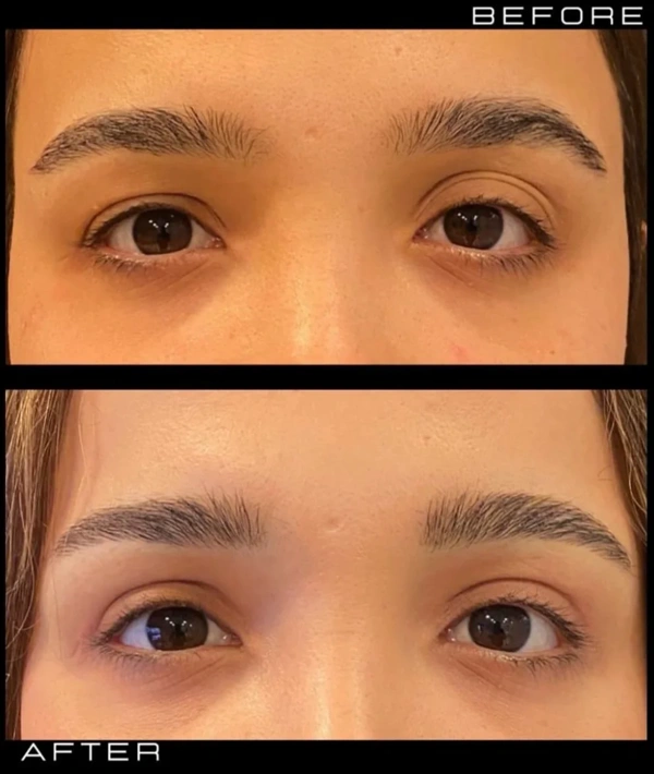 Duran Cekic Blefaroplastie (Operație la pleoape) results in Turkey – case 641