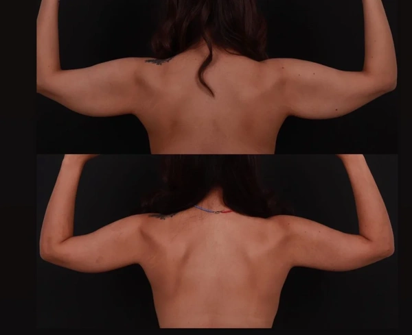Giray  Genc  lifting corporal complet results in Turkey – case 194