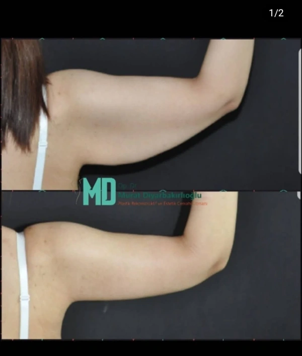 Murat  Diyarbakırlıoglu  lifting corporal complet results in Turkey – case 208