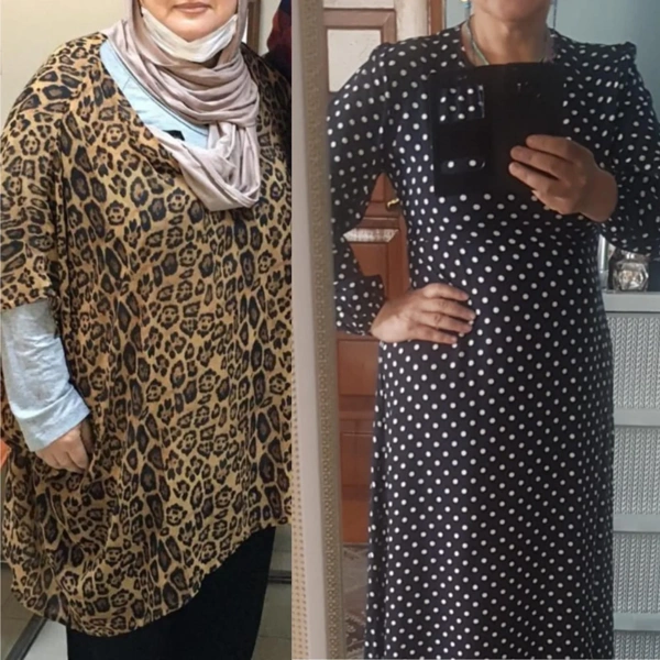 Ibrahim Karatas Sleeve gastric results in Turkey – case 305