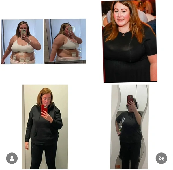 Umut Rıza Gunduz Sleeve gastric results in Turkey – case 505