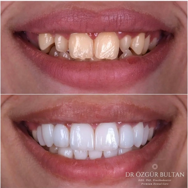 Ozgur  Bultan Fațete dentare results in Turkey – case 330