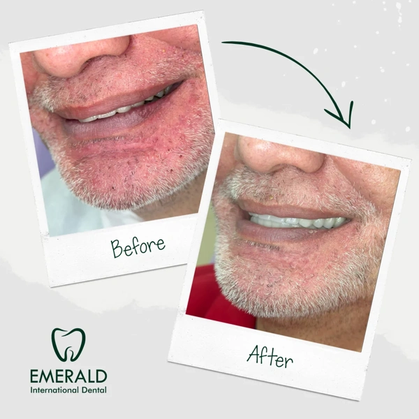 Sami Guvenc Implanturi dentare results in Turkey – case 434