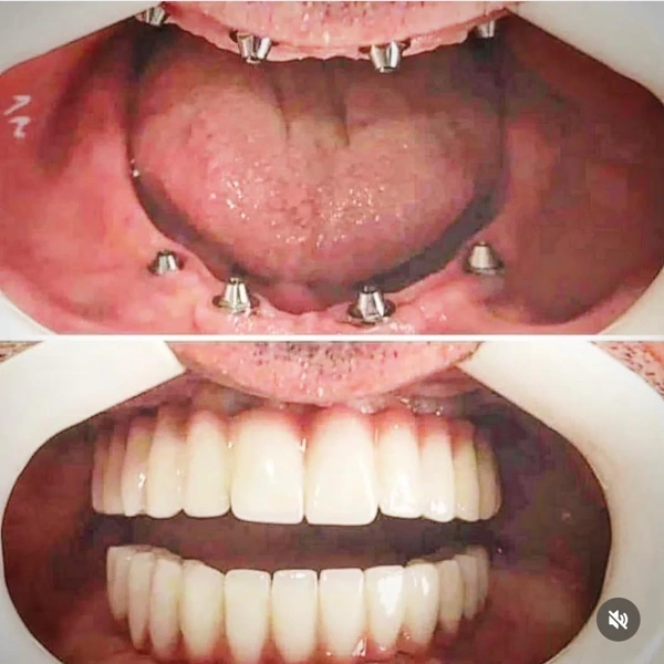 Fikret  Altan Implanturi dentare results in Turkey – case 345