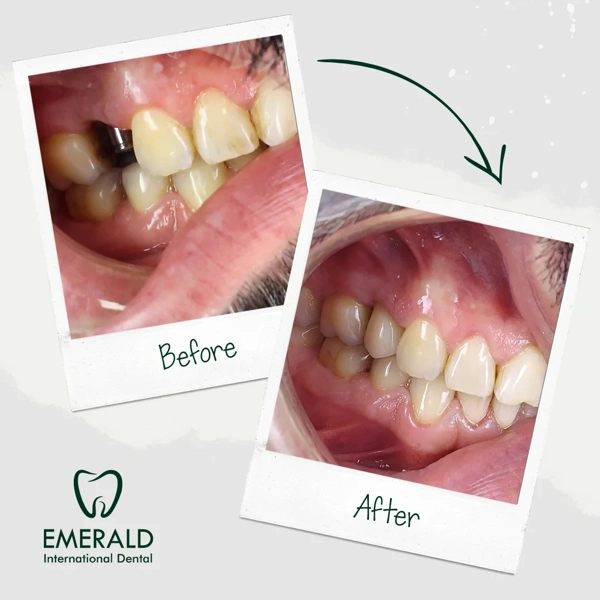 Cemal Onder Implanturi dentare results in Turkey – case 423