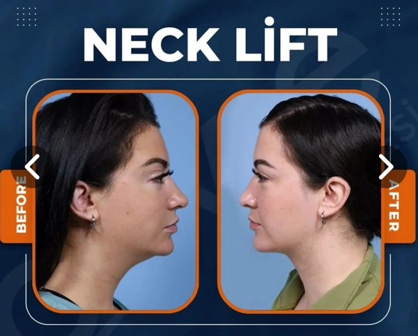 Duran Cekic Lifting Facial results in Turkey – case 92