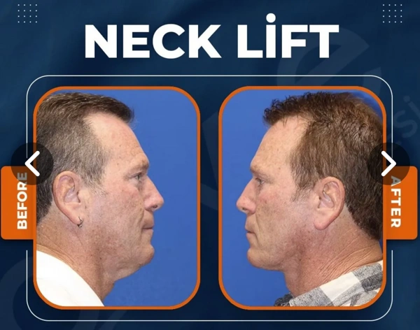 Duran Cekic Lifting Facial results in Turkey – case 93