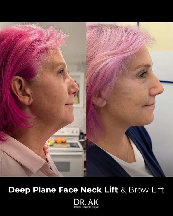 Erman Ak Lifting Facial results in Turkey – case 6