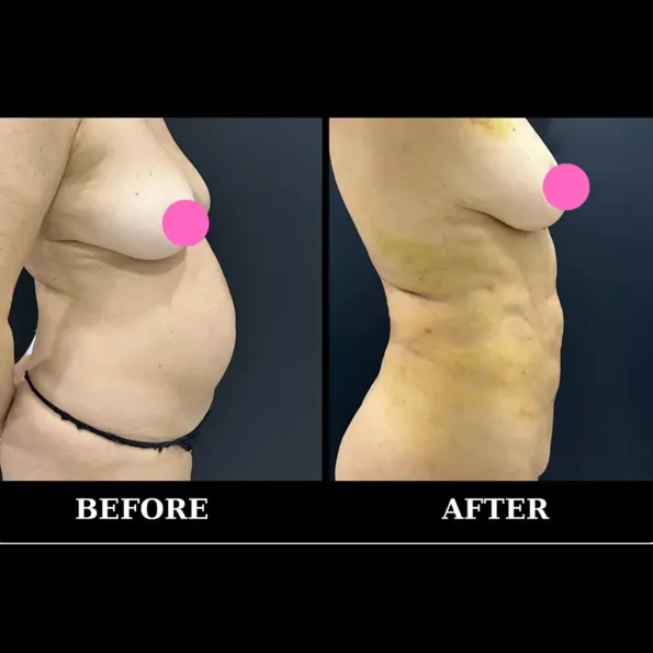 Rezultate înainte și după Liposucție în Turcia – caz 637