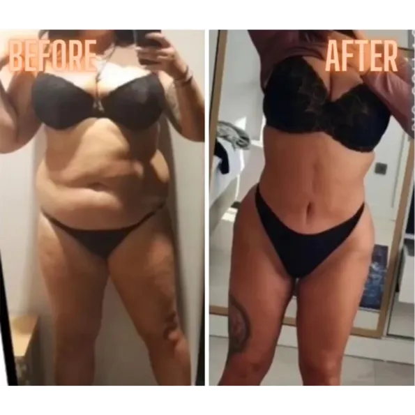 Rezultate înainte și după Liposucție în Turcia – caz 688