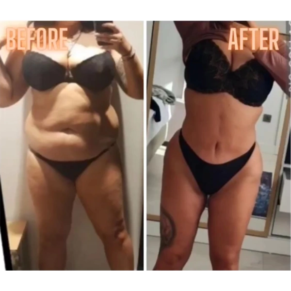 Cagdas Orman Liposucție results in Turkey – case 688