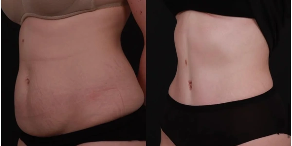Giray  Genc Mommy Makeover results in Turkey – case 193