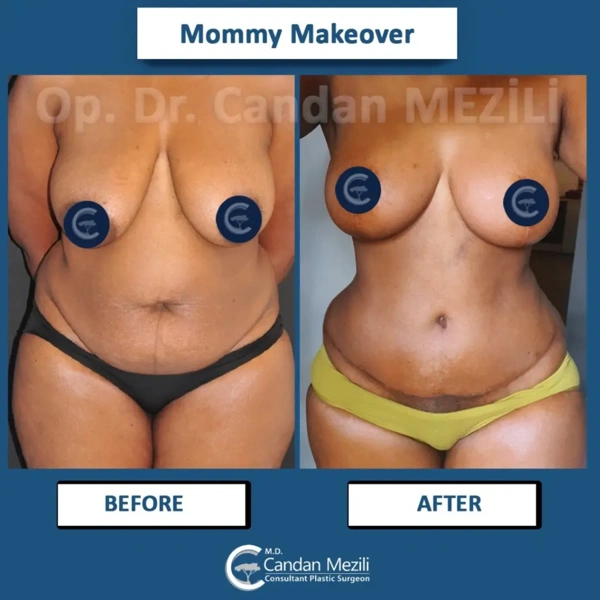 Candan Mezili Mommy Makeover results in Turkey – case 593