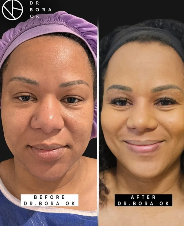 Bora  Ok Rinoplastie (Operație la nas) results in Turkey – case 155