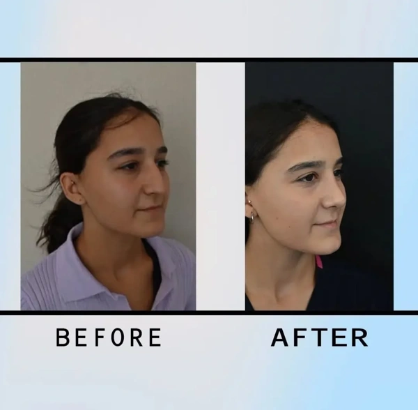 Murat  Diyarbakırlıoglu Rinoplastie (Operație la nas) results in Turkey – case 221