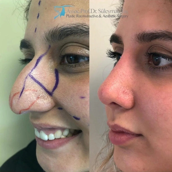 Suleyman  Tas Rinoplastie (Operație la nas) results in Turkey – case 277