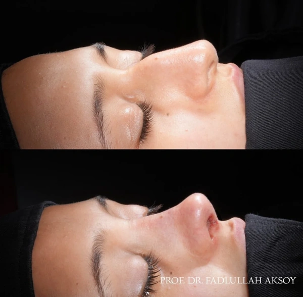 Fadlullah AKSOY Rinoplastie (Operație la nas) results in Turkey – case 492