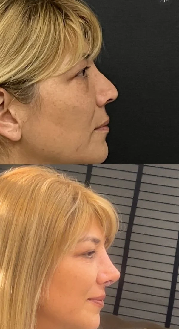 Ismail Deniz Rinoplastie (Operație la nas) results in Turkey – case 498