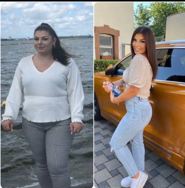 Toygar Toydemir Sleeve gastric results in Turkey – case 250