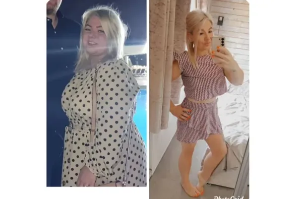 Rezultate înainte și după Balon gastric în Turcia – caz 510
