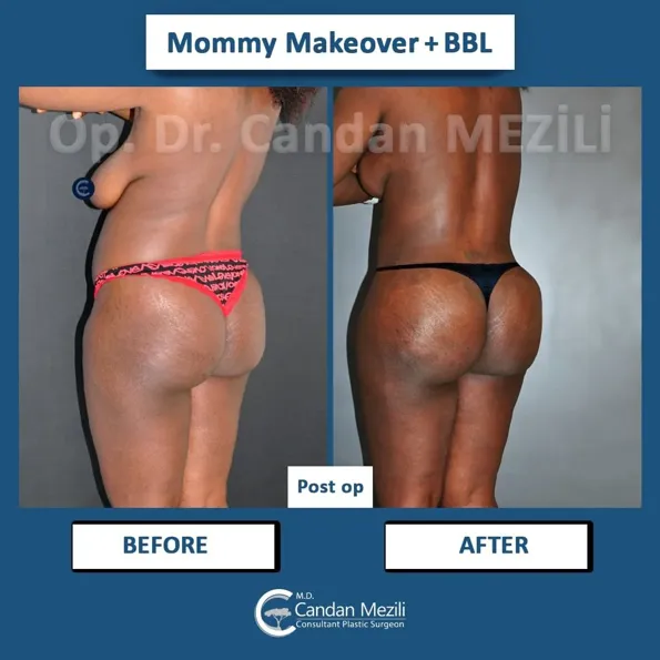 Результаты BBL (Бразильская подтяжка ягодиц) до и после в Турции – случай 445