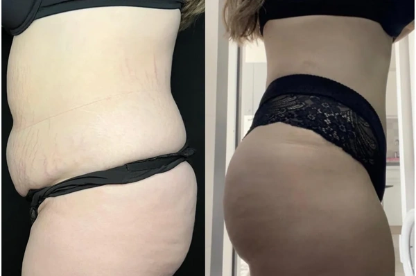 Giray  Genc Mommy makeover results in Turkey – case 192