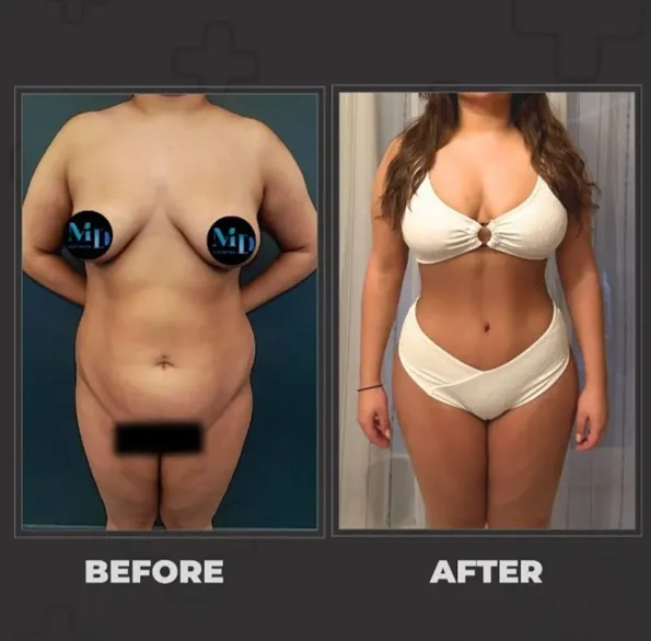 Результаты Mommy makeover до и после в Турции – случай 207