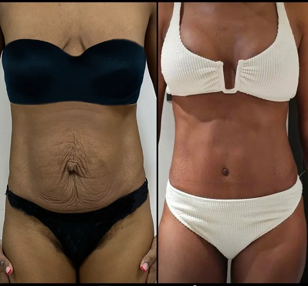 Erman Ak Mommy makeover results in Turkey – case 614