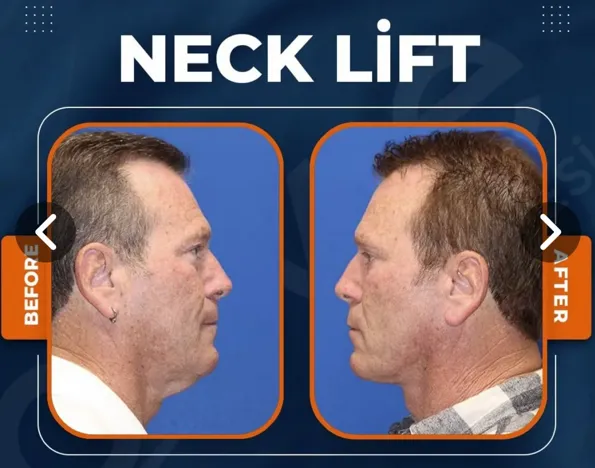Результаты Подтяжка лица (фейслифт) до и после в Турции – случай 93