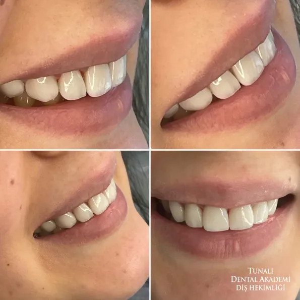 Результаты Установка виниров до и после в Турции – случай 254