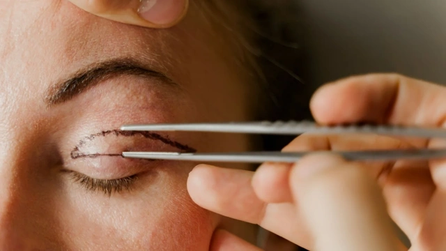 Celebrities Who Have Blepharoplasty