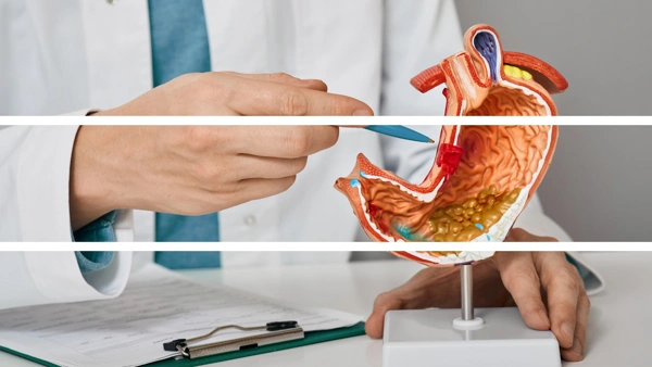  Gastric Sleeve 