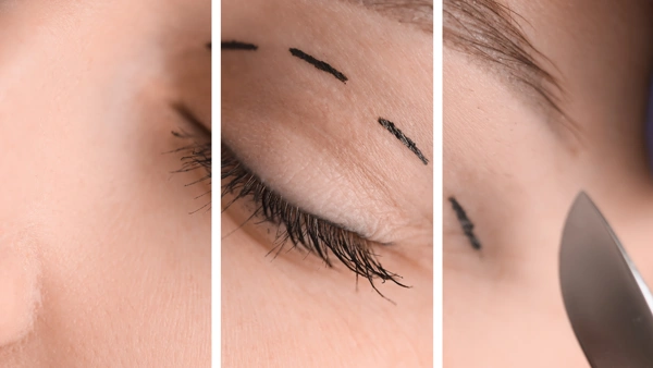  Blepharoplasty
