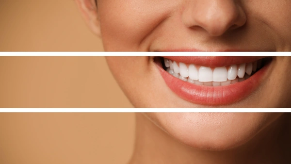  Dental Veneers