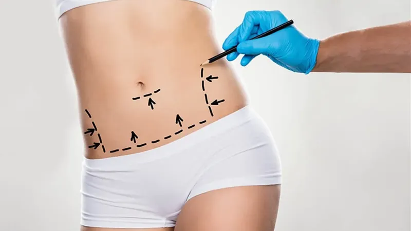 Tummy Tuck (Abdominoplasty)