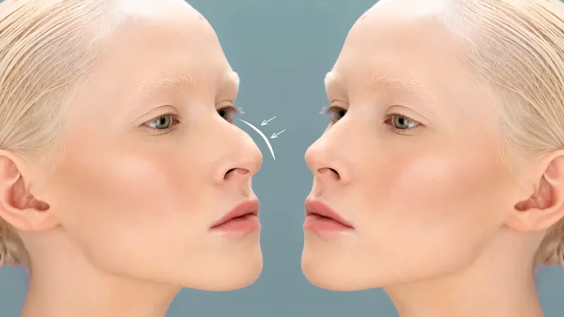 Rinoplastia (Operación de nariz)