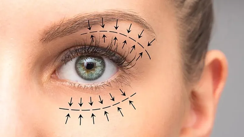Blepharoplasty