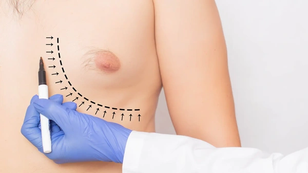 Penisvergrotings chirurgie gecombineerd met procedure 16 in Turkije