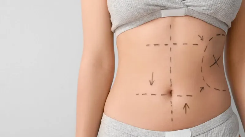 Vaser Liposuction